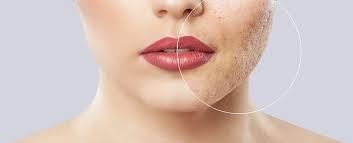 Acne Scar Treatment